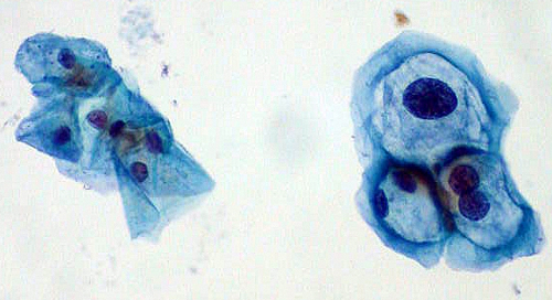Койлоциты и нормальные клетки